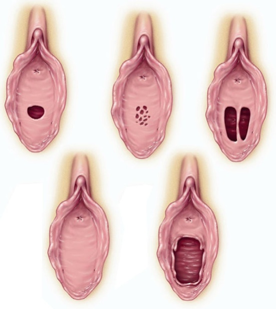 Virgin Pussy Hymen Intact - Examples of Unbroken Hymens | Betty Dodson & Carlin Ross