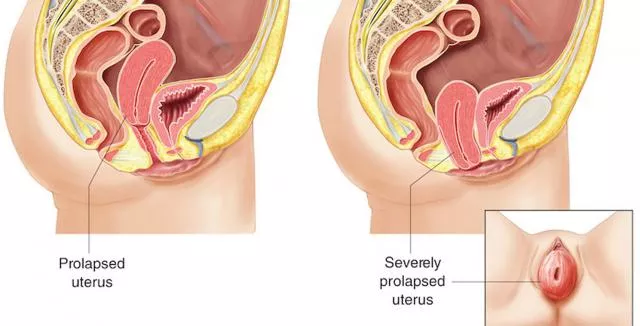 prolapsed uterus Betty Dodson Carlin Ross